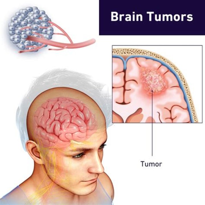 Can brain tumors be caused by environment?