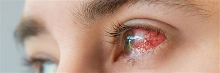 Can well water cause eye infections?