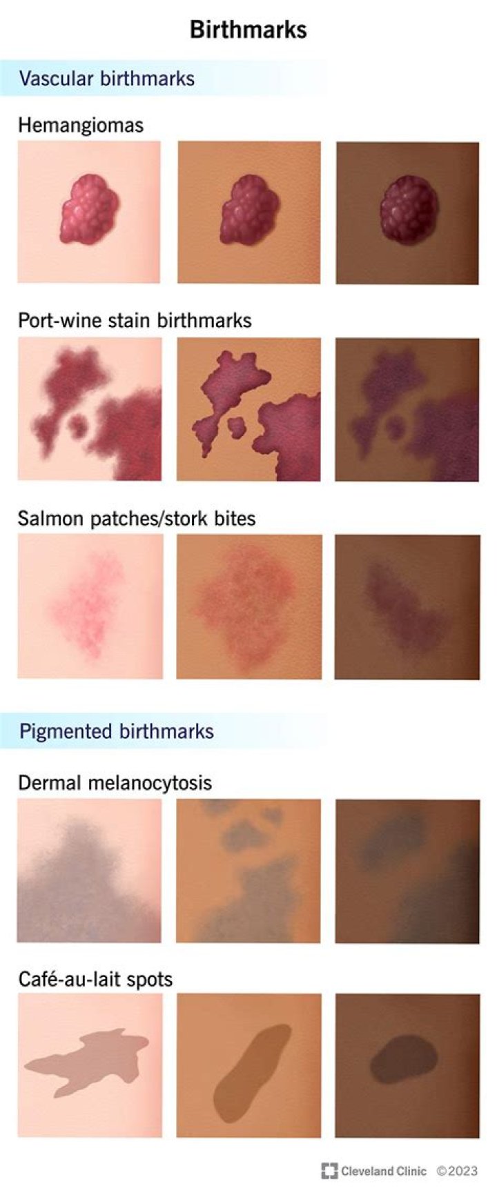 Can you erase a birthmark?