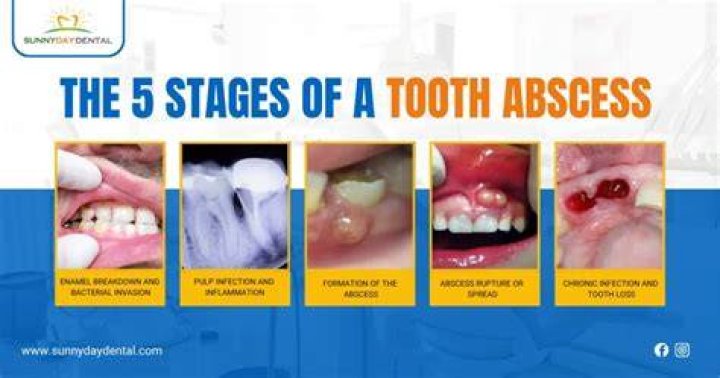 What happens if an abscess tooth pops in your mouth?