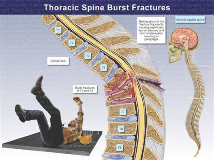 What is Retropulsion of the spine?